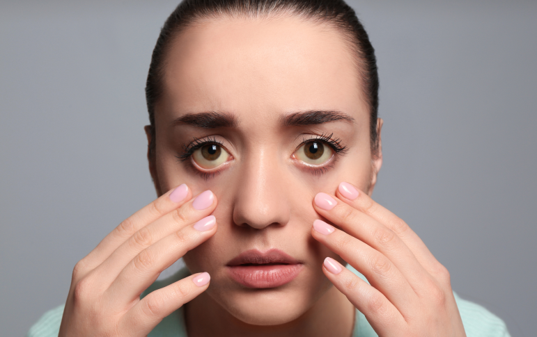 Dealing with Puffy Eyes and Dark Circles