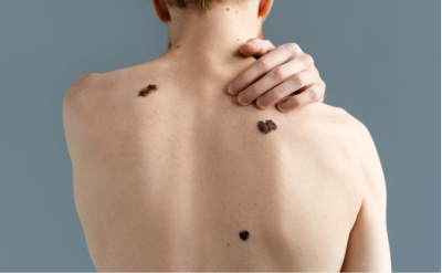 Is it Just a Mole? Understanding the Warning Signs of Melanoma